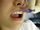 Reinigung der Zahnzwischenräume mit Intradentalbürstchen Reinigung der Zahnzwischenräume mit Intradentalbürstchen