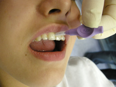 Reinigung der Zahnzwischenräume mit Intradentalbürstchen - Professionelle Zahnreinigung Reinigung der Zahnzwischenräume mit Intradentalbürstchen - Professionelle Zahnreinigung